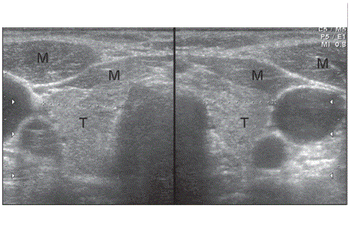 Cervical