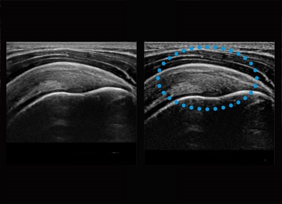 ultrassom ombro2-min