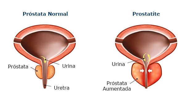 ultrassom prostata1-min