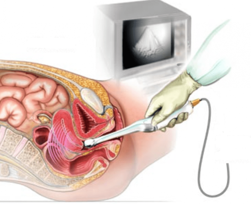 ultrassom transvaginal1-min