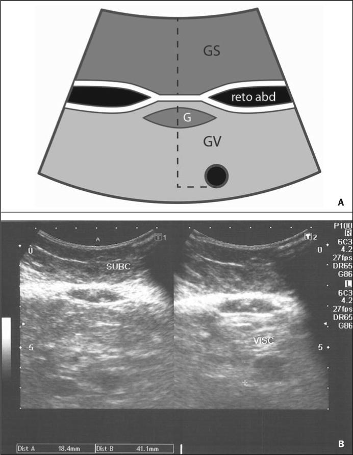 us parede abdominal2-min